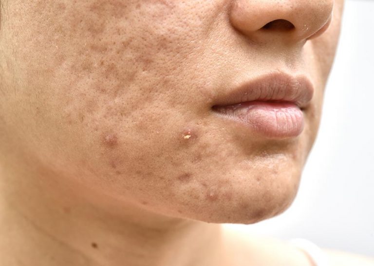 Acne Cravos e Espinhas Você sabe a diferença CliqueFarma