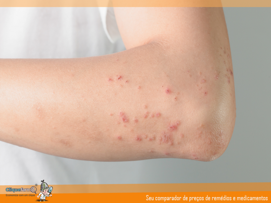 Dermatite At Pica Cliquefarma