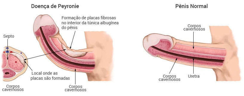 Imagem Complementar da Bula do neprinol afd - 500mg 90 cápsulas - defesa avançada contra fibrina e auxiliar para doença de peyronie